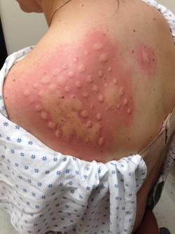 stunningpicture:  So my sister got her allergy test done and