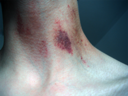 pistanthrofobia:  “Hickey”