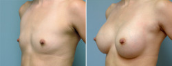 breast augmentation 