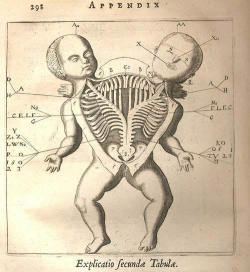 moonfall-requiem:  Anatomical drawing of a Siamese twin. Fortunio