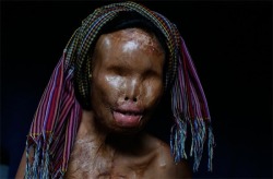 The face of Sokreun Mean, who was blinded and disfigured by an