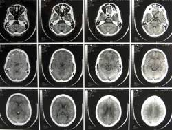 sixpenceee:  Disorders & Their Respective Brain Scans Schizophrenia: patients