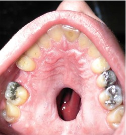 Cocaine-Induced Palatal Perforation