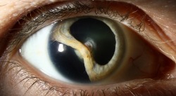 logija:  Traumatic cataract with iridodialysis and lens coloboma