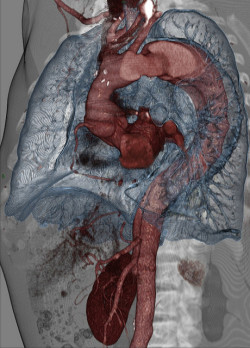 staceythinx:  Volume Rendering CT Scans by voxel123 