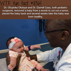 wtf-fun-factss:  Doctor removed a baby from the womb and placed