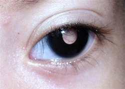 theleoisallinthemind:  Retinoblastoma is a rare type of eye cancer