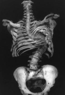asapscience:  A spine after severe and untreated scoliosis. This