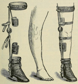 sutured-infection:   Deformity apparatus: Chas. F. Stillman’s