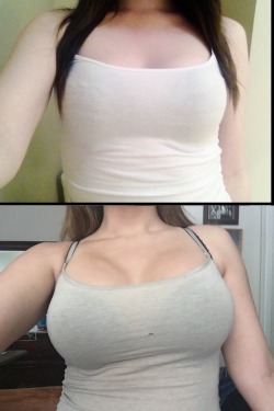 ddorbiggerplease:  kattnippxo:  Before and after my Breast Augmentation! Before surgery I was a 34A, I got 500ccs, smooth rounds, gummy bear gel under the muscle, incision under the breast. Today is 5 days post op and I’m filling out a 34D now! So happy