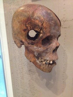 sixpenceee:  Skull from Civil War, this fatal wound was inflicted