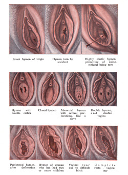 kronstadt21:  Know your hymen. From the Encyclopedia of Sex Practice,