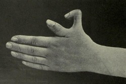 Supernumerary thumb, from Edward M. Foote’s A text-book of
