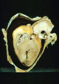 usmlepathslides:  Heart: cardiac tamponade secondary to rupture