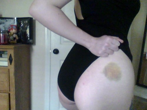 ero-hime:  bruise 