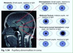 doctordconline:Pupillary Abnormalities in Coma.. #coma  #pupil