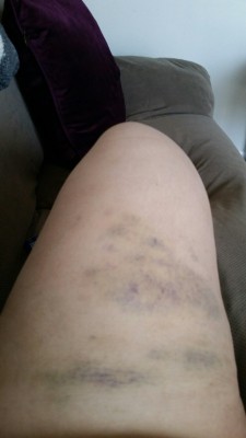 kneel-serve-and-obey:  Steel cane bruises, day 3. This picture