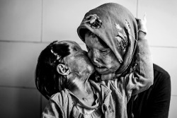  An Iranian woman and her 3 year old daughter, disfigured from