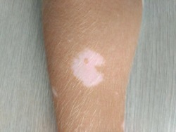 diary-of-a-chinese-kid:  One of my friend’s vitiligo spots