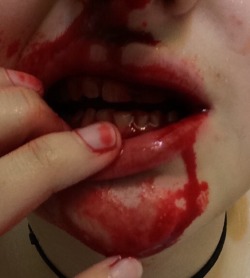 sugarfreeshota:  part 2 of my bloody adventures: nosebleeds in