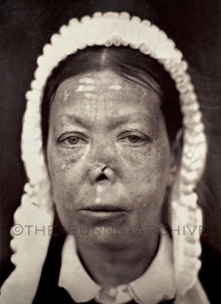 Ozena: Tuberculosis of the Nose, Circa 1870.The dreaded infection
