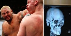 bleacherreport:  UFC fighter Stefan Struve shared his X-rays