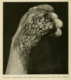 1917. “Radiation burn to the hand Note the necrotic dermatitis