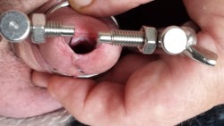 raisa113:    urethral dilatation  