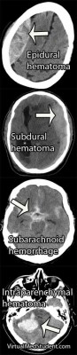 neuronursejess:  Differnt type of hematomas and hemorrhages 
