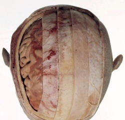 (From right to left): Scalp - Periosteum - Bone - Dura Mater