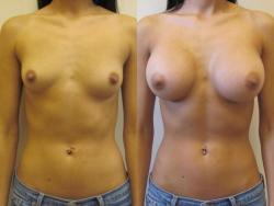 addicted2implants:  i would have let her get bigger ones if she