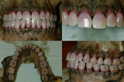 thetemperamentalgoat:  Post Mortem Pink Teeth Phenomenon The