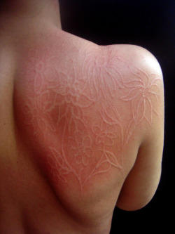 jakewild:   Turning my sister’s dermatographia into art  