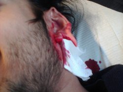 fuckyeahstretchedears:  This was mid procedure for my earlobe