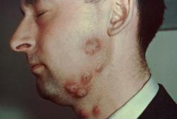  Ringworm of the bearded areas of the face and neck, known as