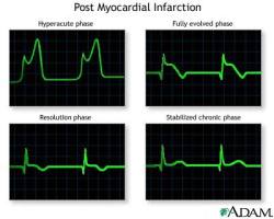 rambling-medic:  How do doctors look at ECGs and determine a