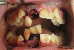 deformutilation:  Dental trauma affecting the right incisors