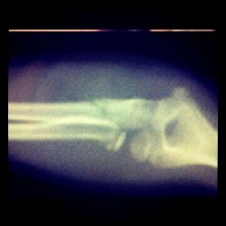 Sophia will be in a cast for six weeks :( (Taken with instagram)