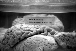 articulomortis:  Brains of Epileptics 