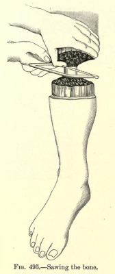 sutured-infection:  From Joseph D. Bryant’s Operative Surgery,