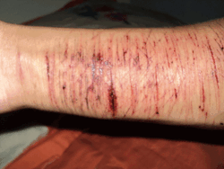 sangue-e-cicatrizes:  Cortes que sangram, feridas profundas,
