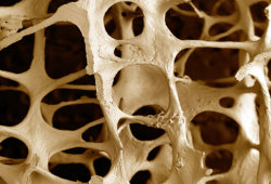 vermis:  Osteoporotic bone 