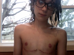 ryancassata-366:  January 26th, 2012 - 3 weeks post-op. 