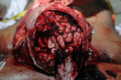 forensicsandpathology:  Subdural hemorrhage - This victim was