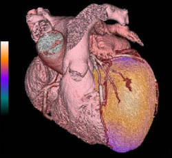 PET/CT angiogram fusion image comprises a volumetric CT angiogram