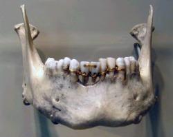  The earliest evidence of ancient dentistry we have is an amazingly