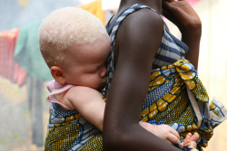 ocean-calliope:  African albino girl in Freetown, Sierra Leone