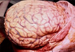 forensicsandpathology:  Global Brain Swelling. 