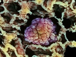 alchymista:  In this scanning electron micrograph, a small cancerous