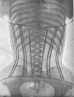 midnight-gallery:  X-Ray image of a corset, (1908) 